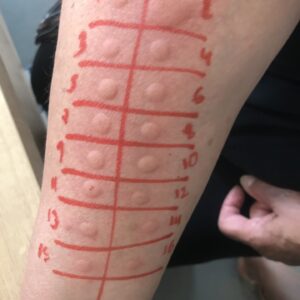 Prick tests 2