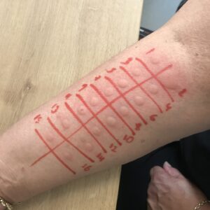 Prick tests 3